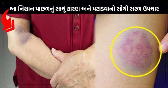 શરીર પર દેખાતા આ નિશાન પાછળ નું સાચું કારણ અને મટાડવાનો સૌથી સરળ ઉપચાર