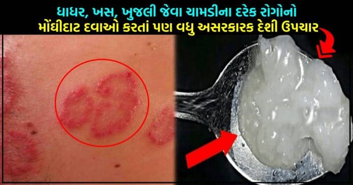 ધાધર, ખસ, ખુજલી જેવા ચામડીના દરેક રોગોનો મોંઘીદાટ દવાઓ કરતાં પણ વધુ અસરકારક દેશી ઉપચાર
