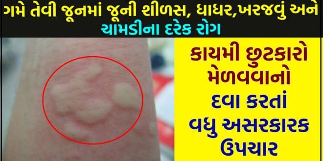 ગમે તેવી જૂનમાં જૂની શીળસ, ધાધર,ખરજવું અને ચામડીના દરેક રોગ માંથી કાયમી છુટકારો મેળવવાનો દવા કરતાં વધુ અસરકારક ઘરેલું ઉપચાર