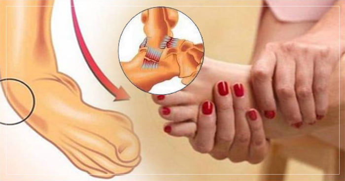 જો અચાનક પગ કે ગરદનમાં મચકોડ આવે તો તરત જ આ કામ કરો, તમને થોડી જ વારમાં દુખાવાથી મળી જશે રાહત