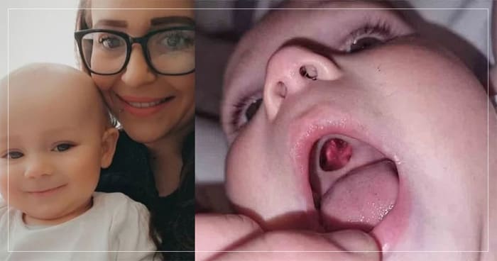 બાળકના તાળવા માં નીકળ્યું કાણું, જલ્દી જ હોસ્પિટલ પહોંચી માતા, સત્ય જાણીને થઇ જશો ચક્તિ..