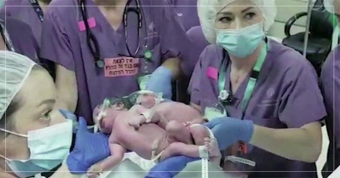 બે જુડવા બહેનો અને શરીરથી જોડાયેલી એક વર્ષની પુત્રીઓને 22 ડોક્ટરોની એક ટીમે 18 કલાકની મહેનત કરીને જીવનદાન આપ્યું, માતા-પિતા પણ..