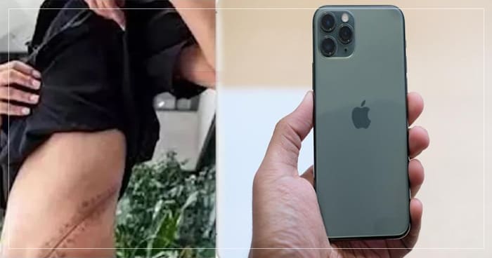ઘોર કળિયુગ, iPhone ખરીદવા માટે છોકરાએ વેચી દીધી પોતાની એક કિડની, હવે આવી રીતે વિતાવી રહ્યો છે જિંદગી..